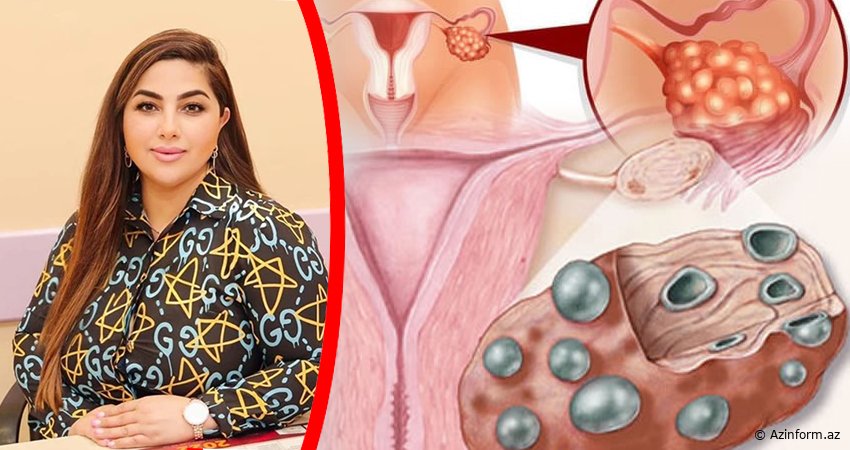 Cərrah mama-ginekoloq Əfsanə Məsimova: "Bu simptomlar sonsuzluğa gətirib çıxarır"