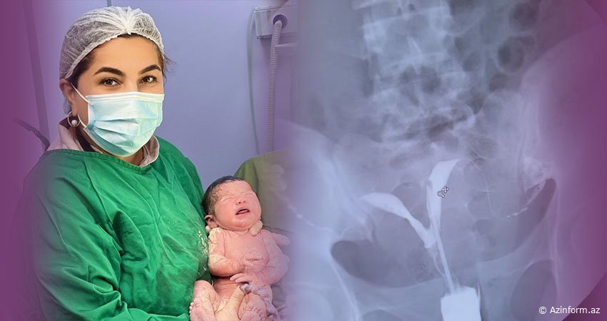 Əfsanə Məsimova: "İki buynuzlu uşaqlıq ilə hamiləlik dövründə düşük riski çoxdur " - VİDEO